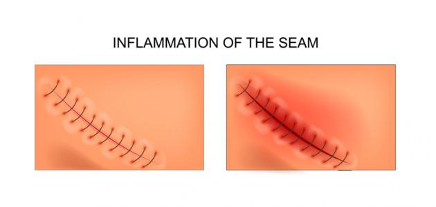 التهاب الجرح بعد الخياطة صورة مقال التهاب الجرح بعد الخياطة