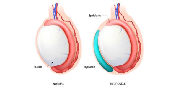 التهاب الخصية اليسرى صورة مقال التهاب الخصية اليسرى