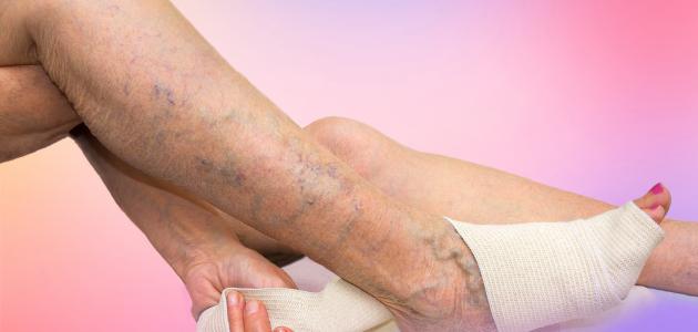 كيفية التخلص من الدوالي في الساقين صورة مقال كيفية التخلص من الدوالي في الساقين