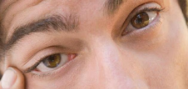 كيف أتخلص من رفة العين صورة مقال كيف أتخلص من رفة العين