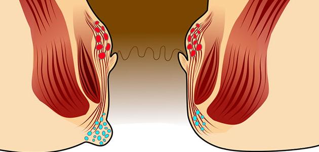 أسباب الناسور صورة مقال أسباب الناسور