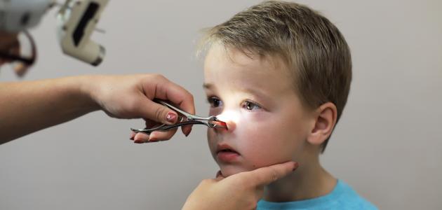 أعراض وجود اللحمية عند الأطفال صورة مقال أعراض وجود اللحمية عند الأطفال