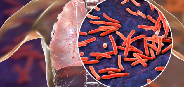 ما هو الدرن وهل هو معدي صورة مقال ما هو الدرن وهل هو معدي