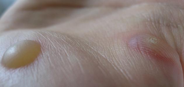 كيفية التخلص من عين السمكة صورة مقال كيفية التخلص من عين السمكة