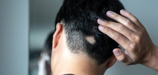 كيفية القضاء على الثعلبة صورة مقال كيفية القضاء على الثعلبة