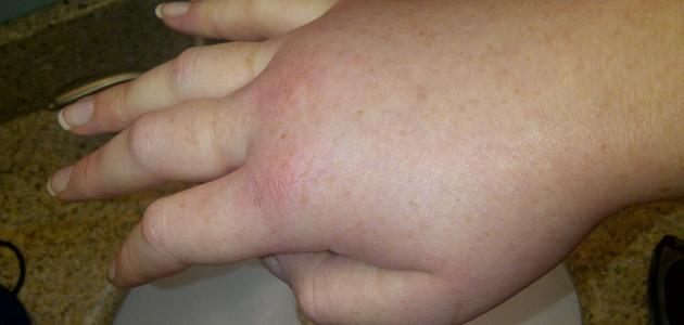 ما سبب انتفاخ القدمين واليدين صورة مقال ما سبب انتفاخ القدمين واليدين