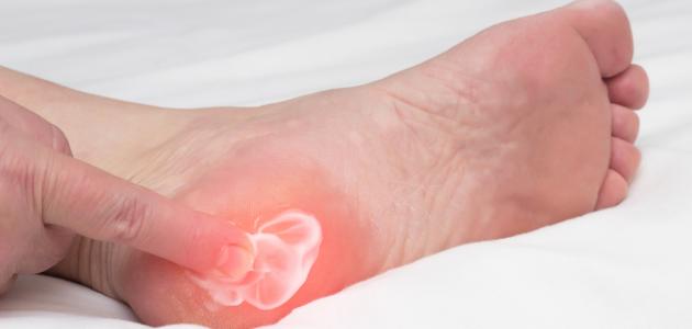 ما علاج مسمار العظم صورة مقال ما علاج مسمار العظم