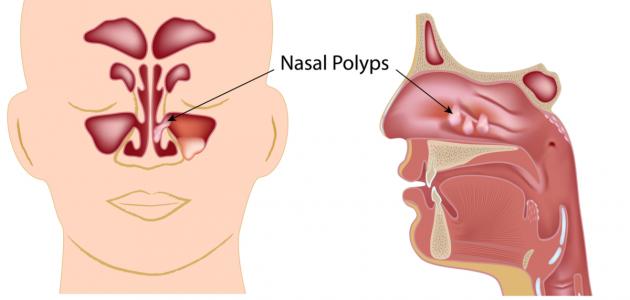 كيفية علاج لحمية الأنف صورة مقال كيفية علاج لحمية الأنف