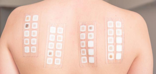 اختبار الحساسية صورة مقال اختبار الحساسية