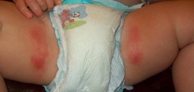 كيف أعالج تسلخات الاطفال صورة مقال كيف أعالج تسلخات الاطفال