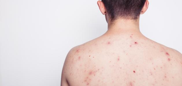 إزالة آثار الحبوب من الجسم صورة مقال إزالة آثار الحبوب من الجسم