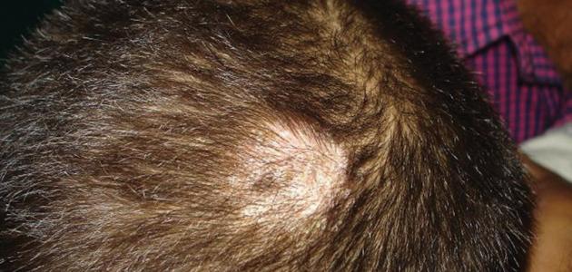 ما أسباب الثعلبة صورة مقال ما أسباب الثعلبة