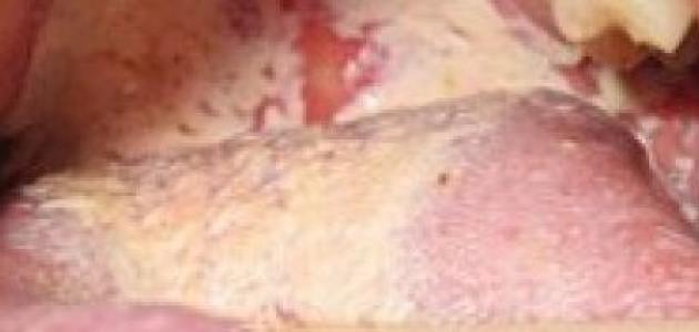 ما أسباب فطريات الفم صورة مقال ما أسباب فطريات الفم