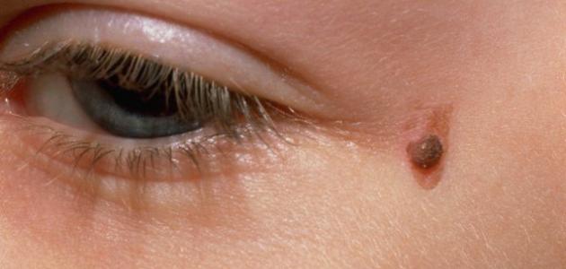 كيف أزيل الثآليل من الوجه صورة مقال كيف أزيل الثآليل من الوجه