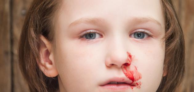 ما أسباب الرعاف عند الاطفال صورة مقال ما أسباب الرعاف عند الاطفال