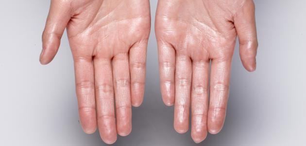 كيف أتخلص من تعرق اليدين صورة مقال كيف أتخلص من تعرق اليدين