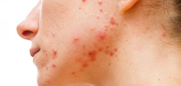 ما هو أفضل حل لحب الشباب صورة مقال ما هو أفضل حل لحب الشباب