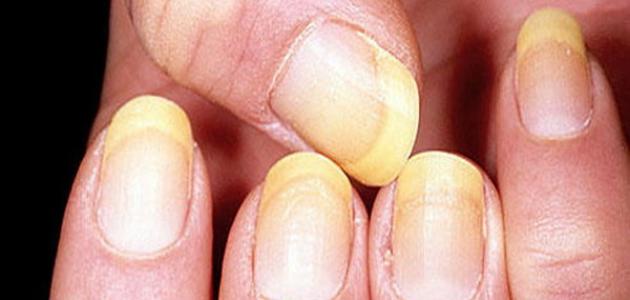 ما هو سبب إصفرار الأظافر صورة مقال ما هو سبب إصفرار الأظافر