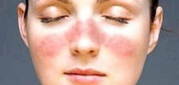 ما علاج قشرة الوجه صورة مقال ما علاج قشرة الوجه