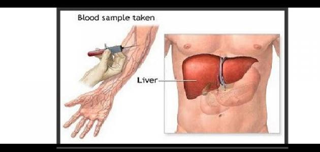 ما هو تحليل البيليروبين صورة مقال ما هو تحليل البيليروبين