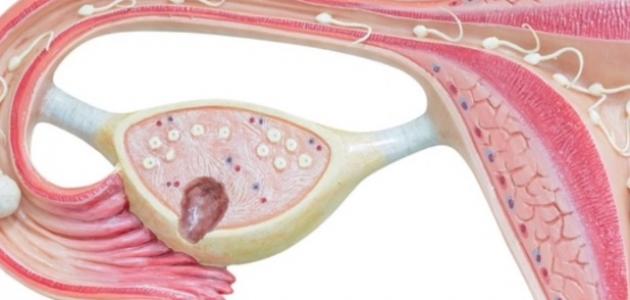 ما هي أسباب وجود كيس على المبيض صورة مقال ما هي أسباب وجود كيس على المبيض