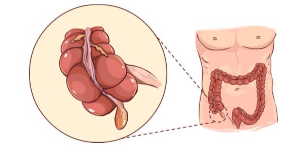 ما هو المصران الأعور صورة مقال ما هو المصران الأعور