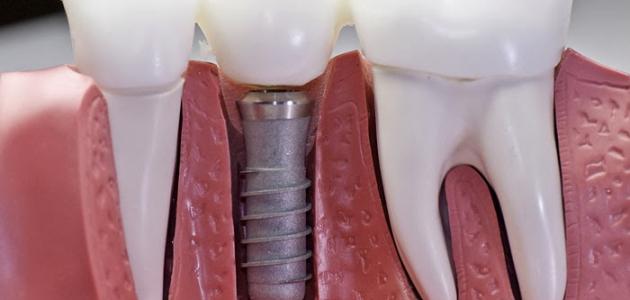ما هي زراعة الأسنان صورة مقال ما هي زراعة الأسنان