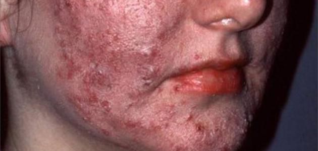 ما هو داء الحفر صورة مقال ما هو داء الحفر