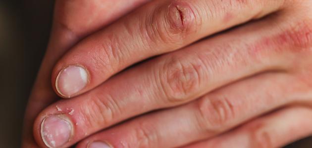 ما هي أعراض نقص الكالسيوم صورة مقال ما هي أعراض نقص الكالسيوم