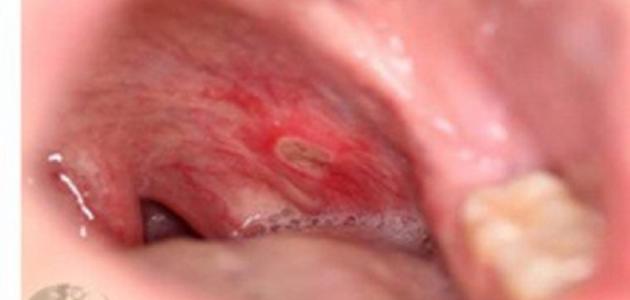 ما هي أعراض قرحة القولون صورة مقال ما هي أعراض قرحة القولون