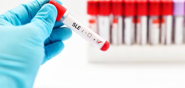 ما هي الذئبة الحمراء صورة مقال ما هي الذئبة الحمراء