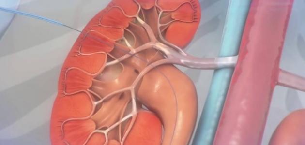 ما هي قسطرة الحالب صورة مقال ما هي قسطرة الحالب