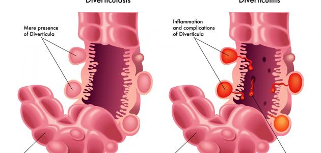 ما هي أعراض الناسور صورة مقال ما هي أعراض الناسور