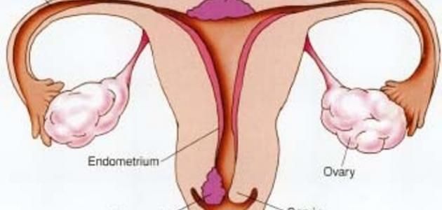 ما هي أعراض التهابات عنق الرحم صورة مقال ما هي أعراض التهابات عنق الرحم