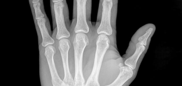 من مكتشف أشعة X صورة مقال من مكتشف أشعة X