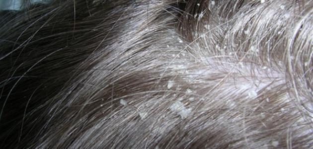 إزالة قشرة الشعر بخل التفاح صورة مقال إزالة قشرة الشعر بخل التفاح