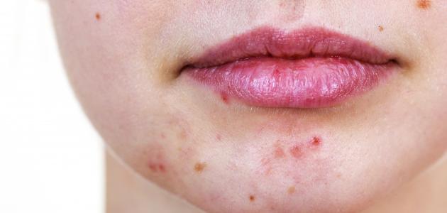 طرق علاج حب الشباب بسرعة صورة مقال طرق علاج حب الشباب بسرعة