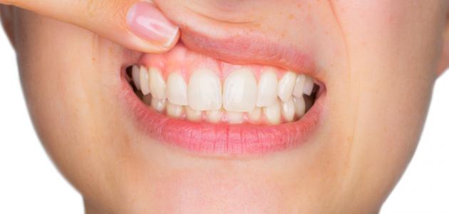 طرق علاج التهاب اللثة صورة مقال طرق علاج التهاب اللثة