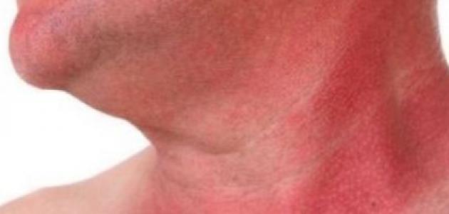 طريقة إزالة حروق الشمس من الوجه صورة مقال طريقة إزالة حروق الشمس من الوجه