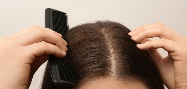 طرق لإزالة القشرة من الشعر صورة مقال طرق لإزالة القشرة من الشعر