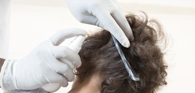 طريقة سريعة للتخلص من القمل والصيبان صورة مقال طريقة سريعة للتخلص من القمل والصيبان