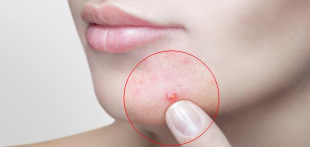 كيف أتخلص من حب الشباب في الوجه صورة مقال كيف أتخلص من حب الشباب في الوجه