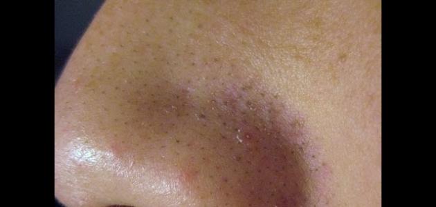 كيف أزيل الرؤوس السوداء من الأنف صورة مقال كيف أزيل الرؤوس السوداء من الأنف