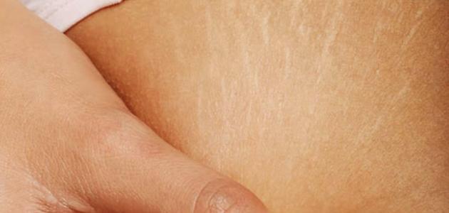 كيف أحافظ على بطني من تشققات الحمل صورة مقال كيف أحافظ على بطني من تشققات الحمل