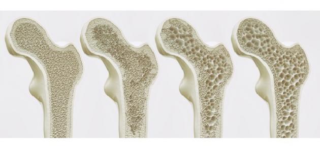 بحث عن هشاشة العظام صورة مقال بحث عن هشاشة العظام