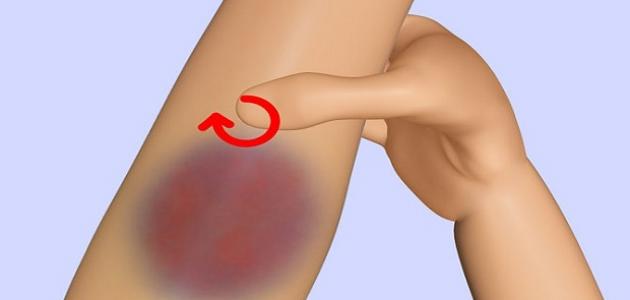كيفية علاج كدمات الضلوع صورة مقال كيفية علاج كدمات الضلوع