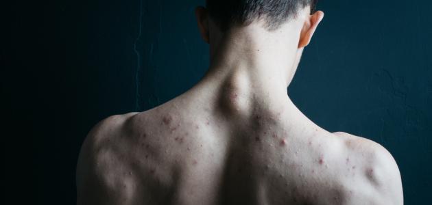 كيف أتخلص من حبوب الظهر صورة مقال كيف أتخلص من حبوب الظهر