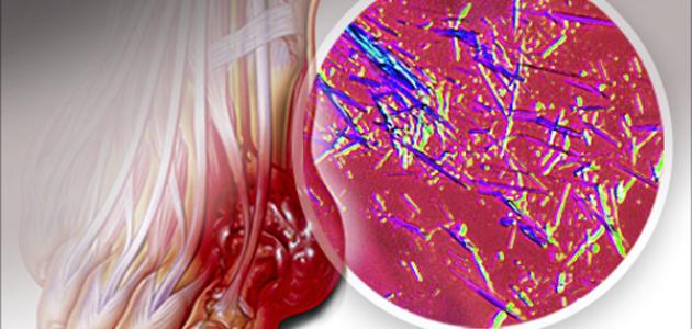 ارتفاع اليوريك أسيد صورة مقال ارتفاع اليوريك أسيد