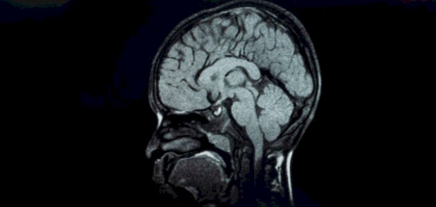 ضمور المخيخ عند الأطفال صورة مقال ضمور المخيخ عند الأطفال