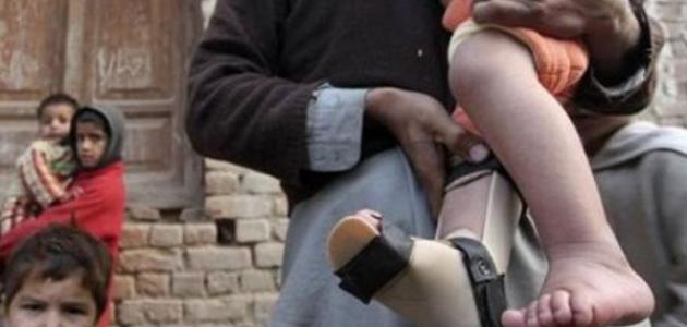 شلل الأطفال عند الكبار صورة مقال شلل الأطفال عند الكبار